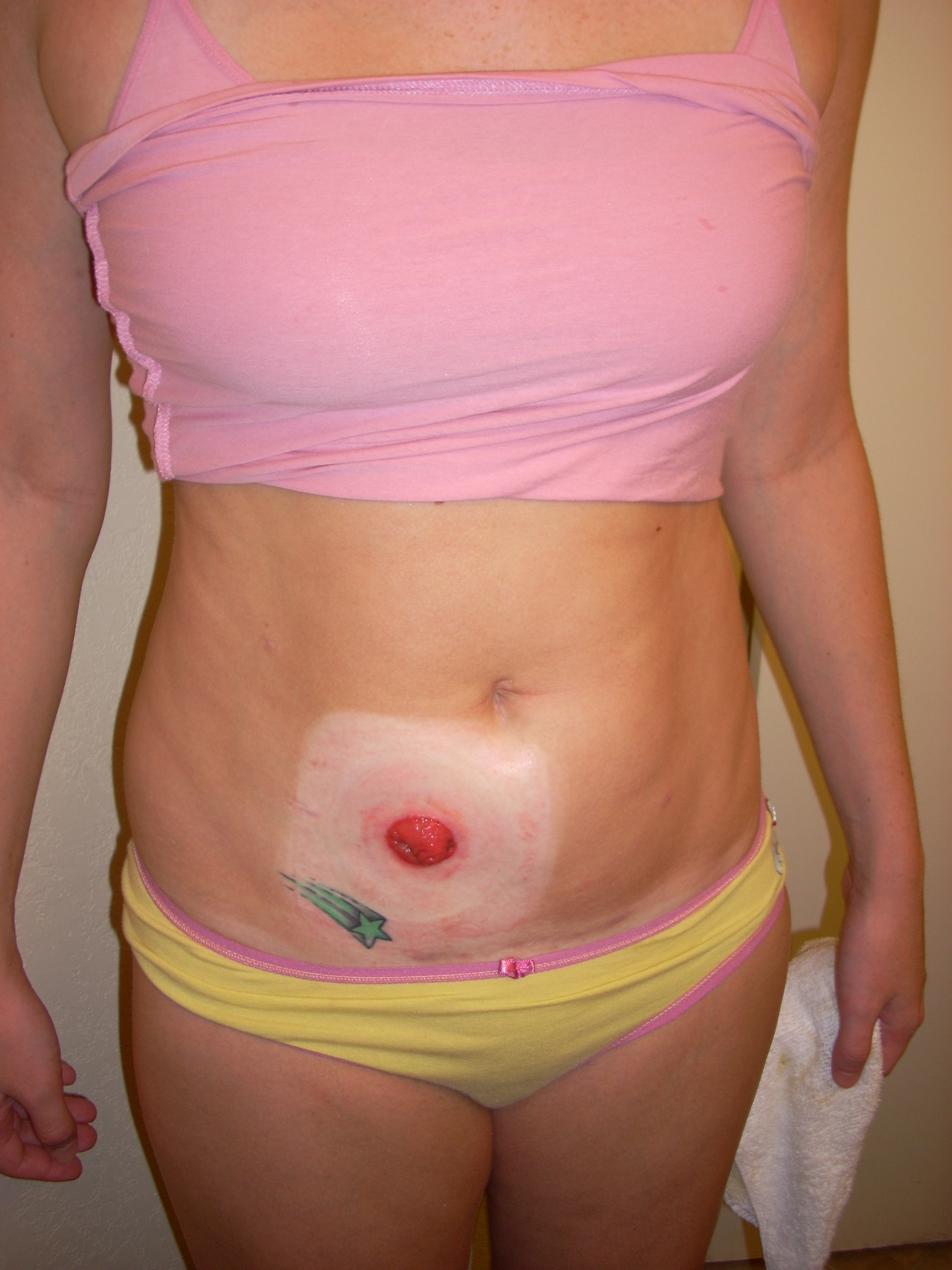 Normal Stoma