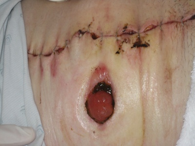 My incision after step 2's emergency reopening
