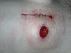 My incision and stoma after step one